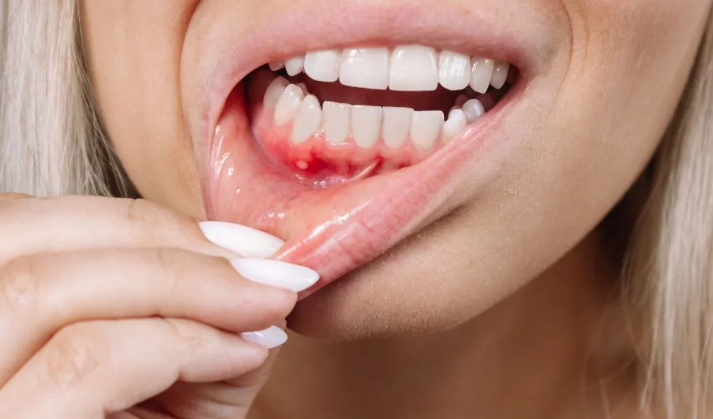 déchaussement des dents