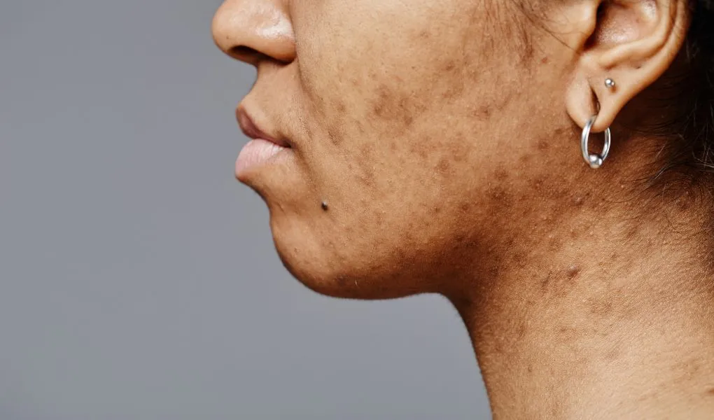 taches brunes sur le visage